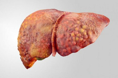 Qaraciyər piylənməsindən dərmansız xilas yolu: ABŞ alimləri "oruc tutun" deyirlər