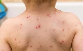 Qızılcaya yoluxmuş şəxslə təmasda olanlar karantinə alınacaqlar?