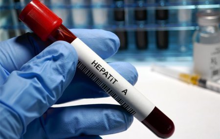 Hepatit A infeksiyasına yoluxma halları ilə bağlı Azərbaycan Respublikası Səhiyyə Nazirliyinin MƏLUMATI