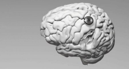 Çin insan beyninə implant yerləşdirdi: Artıq düşüncə ilə videooyun oynayır