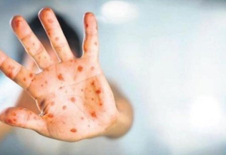 Meymunçiçəyi həmsərhəd ölkədə - Azərbaycanda yoluxma qeydə alınıb?